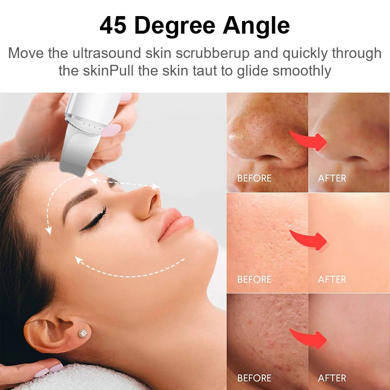 Ultrasonic Blackhead Remover - Deep Pore Cleansing & Lifting Tool